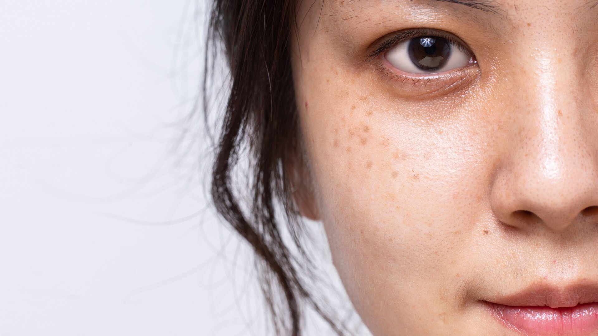 Post-Treatment Care for Dark Spots and Scars